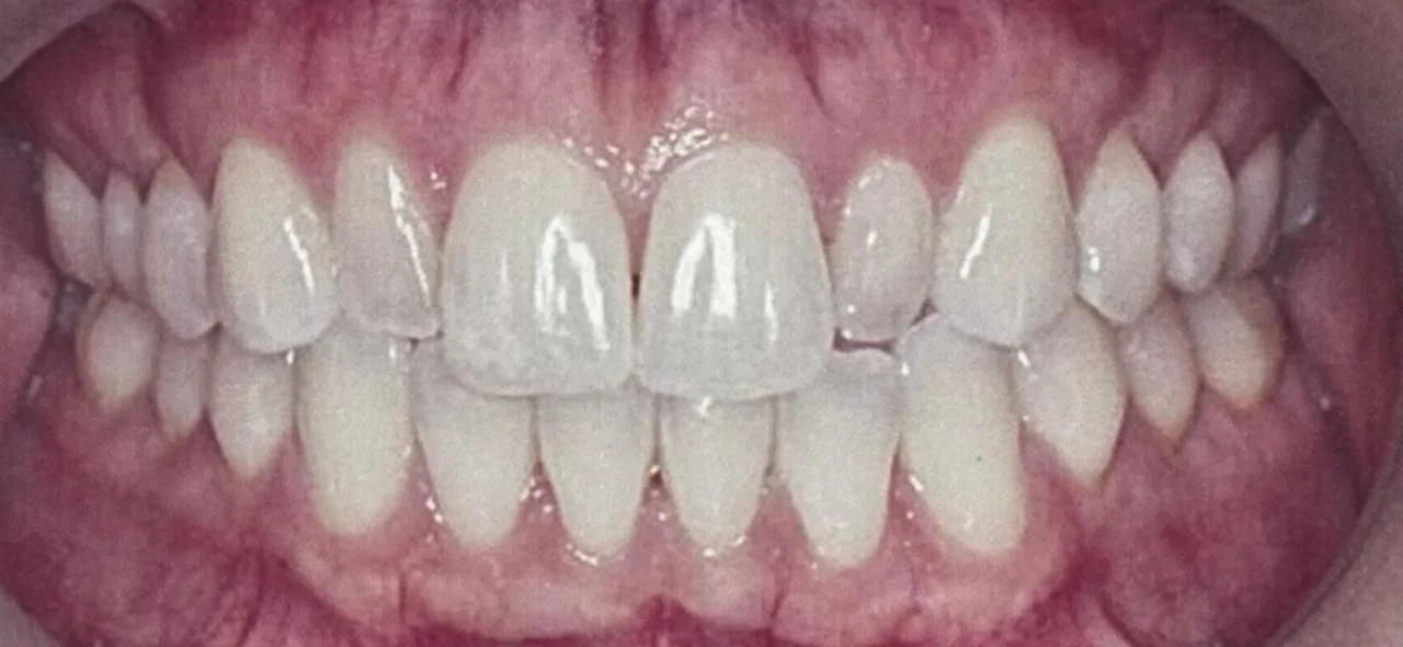 Antes